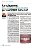 Remplacement d'une incisive centrale maxillaire par un implant monobloc