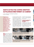 Dents Extraites Comme Greffon Autologue Directement Au Cabinet