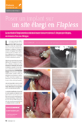 Poser un implant sur
un site élargi en Flapless