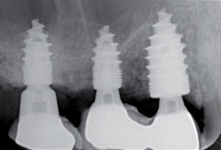 MIMI®-Flapless Sofortimplantation: „Kranker Zahn raus, gesunde Wurzel rein”